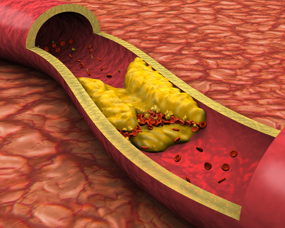 Dislipidemia (Colesterol e Triglicerídeos Elevados)